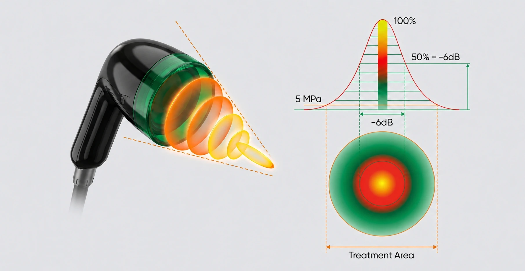 Concetto di applicatore a onde d'urto focalizzate con rilascio mirato dell'energia verso strutture anatomiche profonde